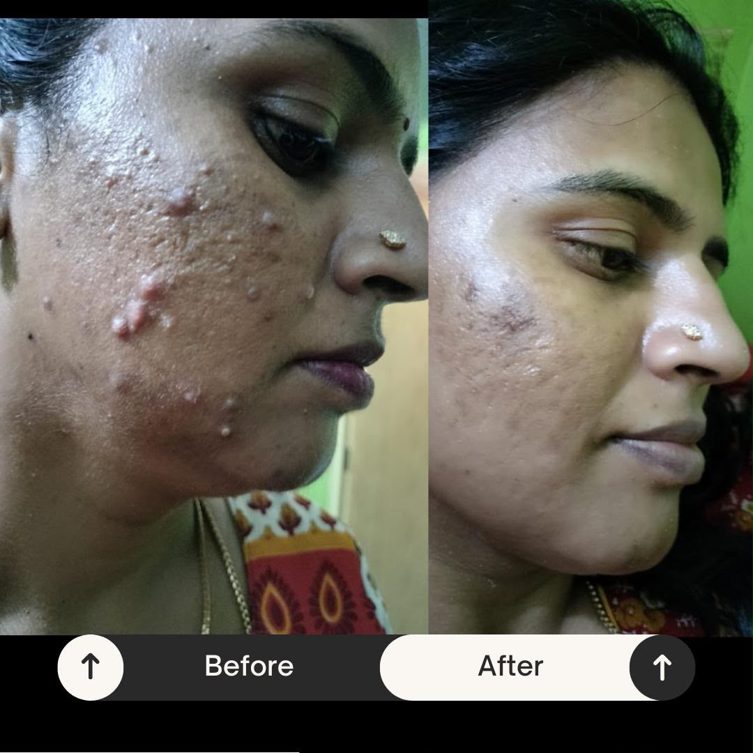 Before and after acne treatment comparison